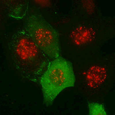 Cancer cells with proteins stained green and red