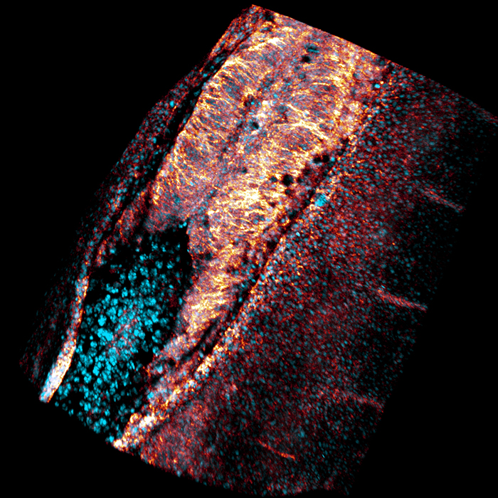 Neural tube defect in quail