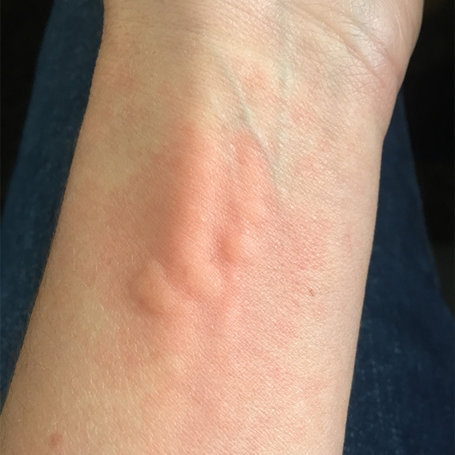 Stinging tree sting