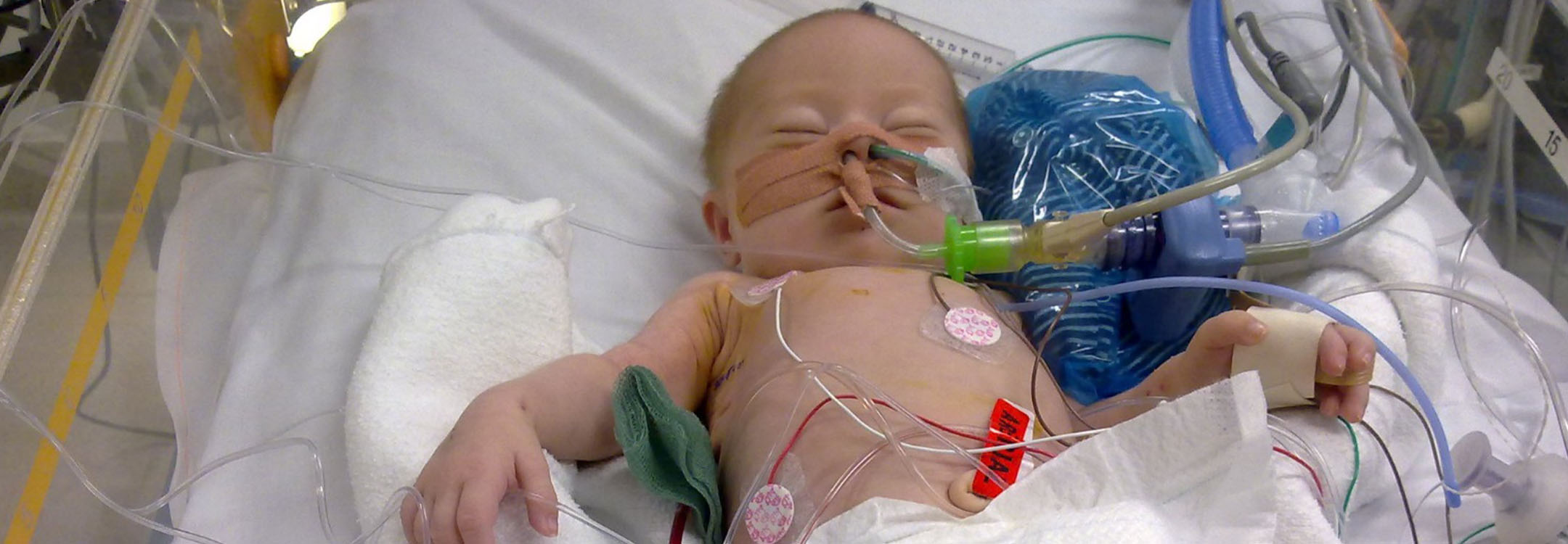 An IMB donor’s child had palliative heart surgery at five weeks of age (picture used with permission).