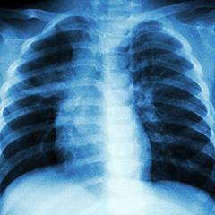 tuberculosis