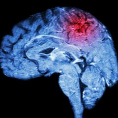 Venom protein could prevent brain damage caused by stroke