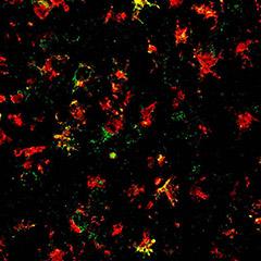 The NLRP3 inflammasome (green) is expressed by immune cells (red) in the brains of people with Parkinson’s disease.
