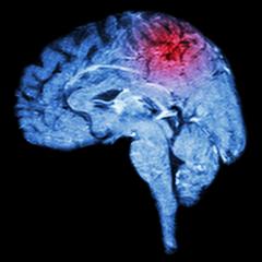 The science of stroke